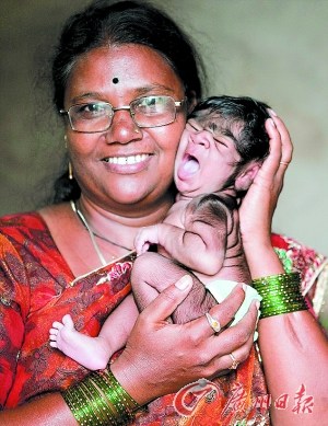 印度一名女婴患家传怪病身体多毛酷似狼孩（图）