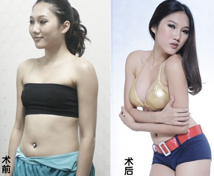 <em>东莞打工妹</em>隆胸+小孩哺乳有伤害?