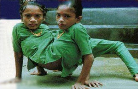 盘点全球最奇特的连体人