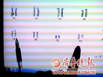烟台一女子婚后11年未育 染色体异常为世界首例