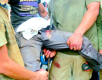 济南农民工大腿被一米多长拇指粗钢筋刺穿