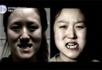 韩国一双胞胎因下巴长整容 数次手术仍一模一
