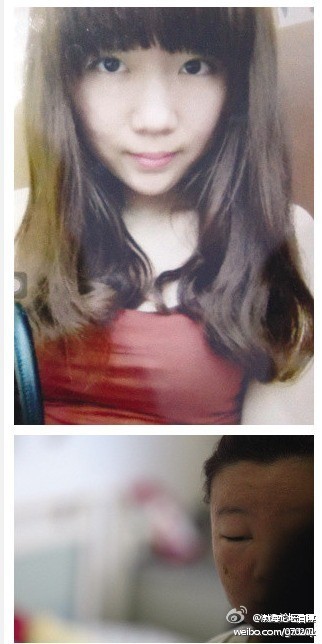 19岁漂亮<em>女孩祛痘</em>差点毁容 中国10年毁20万张