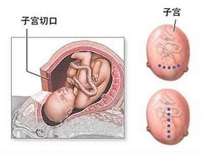 产房揭秘:图解剖腹产全过程(组图)