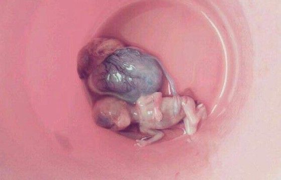 原图·· 血淋漓的堕胎照片,看了你还忍心堕胎吗?