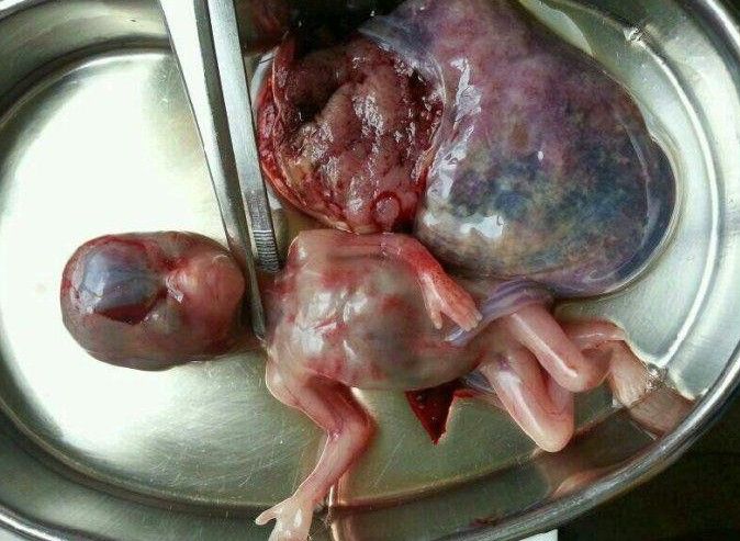血淋漓的堕胎照片+看了你还忍心堕胎吗?