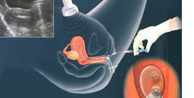 实拍:人工取卵受精全过程(组图)
