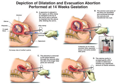 图解:人流手术过程模拟(图)_亲子频道_凤凰网