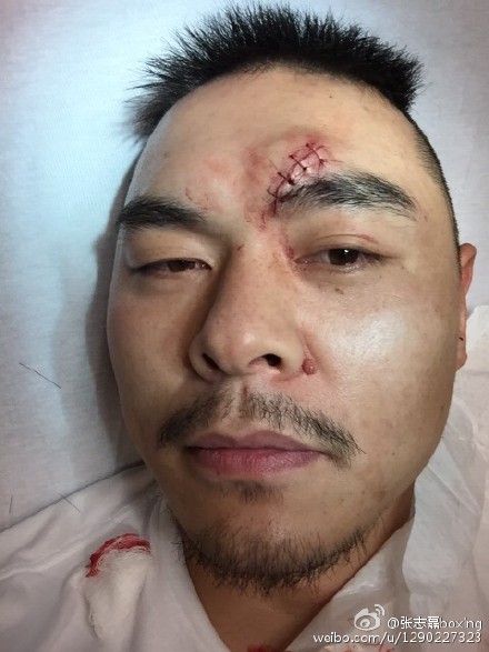 张志磊ko对手豪取五连胜 比赛中额头撞伤缝六针(图)