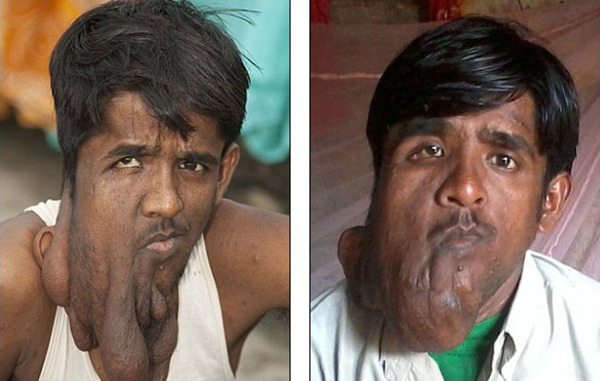 印度23岁的男子拉利特·拉姆手术前（左）和手术后（右）（网页截图）