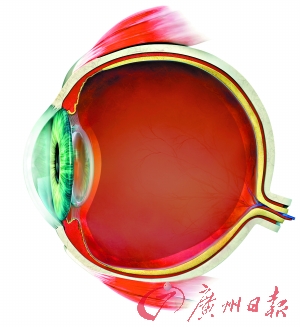 人工虹膜:改变你的眼色|虹膜|眼睛