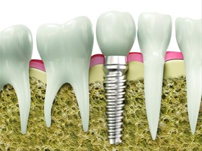 水激光种植牙牙缺失老人的健康保障|烤瓷牙|医