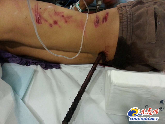 南京:工人高空作业不慎坠落 钢筋穿身命悬一线