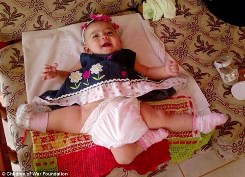 三腿女婴前往美国接受免费治疗 体内还有三个