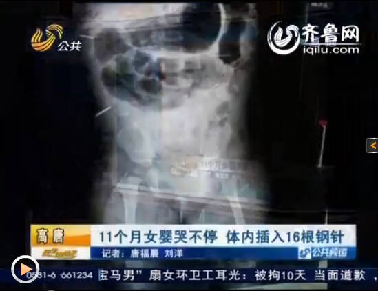 聊城：11个月女婴体内被插入16根钢针医生束手无策
