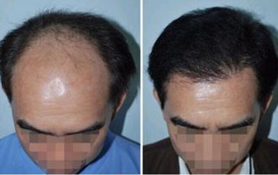 自体毛发<em>移植</em>彻底拯救脱发|<em>头发</em>|脱发_凤凰资讯