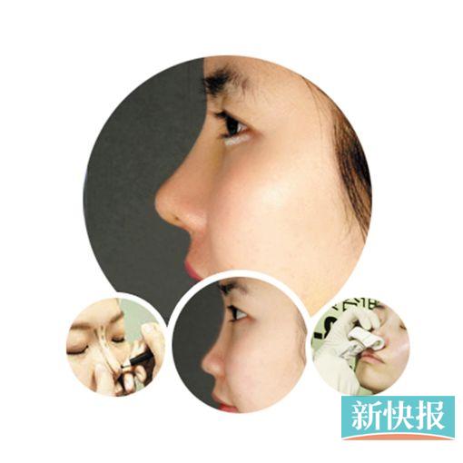 24岁的惠州姑娘李小姐送给自己的玻尿酸注射