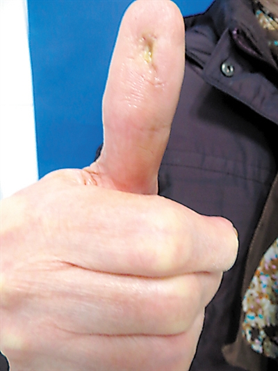 老人大拇指伤口现已基本愈合,处于恢复期。受访者供图