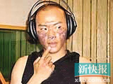 4月初陈志朋在微博晒出之前拍戏烧伤照,自称“当时真勇敢”