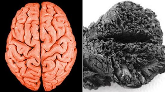 完好的人脑和已保存4000年的人脑对比图