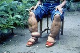 象皮病

患有这种病的病人的腿和胳膊会显得非常肿胀。这种病可能是由蚊子传染导致的，全球大约有1200万的患者。

