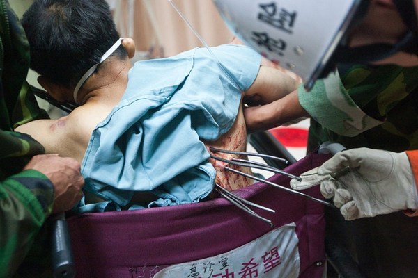 男子被七根钢筋穿透 治疗后高位截瘫