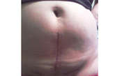 剖腹产横切给女人肚皮留下的疤痕