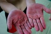 杭州，常年练体操的孩子，伸出手来，手掌上是一层厚厚的茧子，摸起来硬硬的。最初是手上磨出水泡，破一次就长一层茧子。

