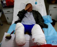 安徽自锯病脚男子已接受截肢手术