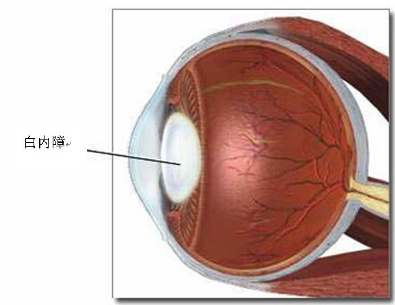 后囊膜连续环形撕囊联合或不联合前部玻璃体切除对儿童后发性白内障