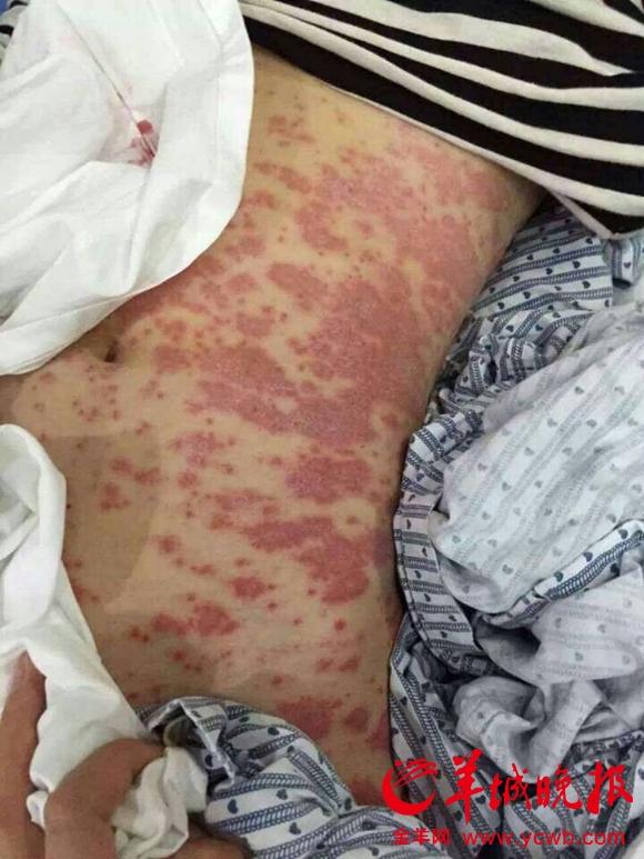 <em>广州女白领</em>美肤后全身长红斑 危及生命(图)_广