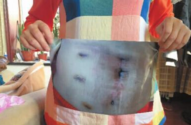 李女士手术后的腹部照片(本报记者 王强摄)