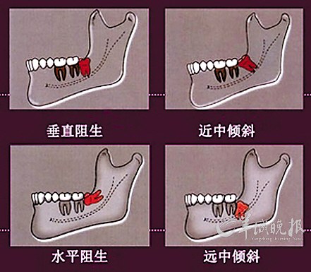 拔智齿不可能瘦脸