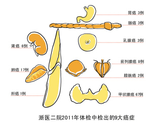 每500个体检者中就有一个查出癌症