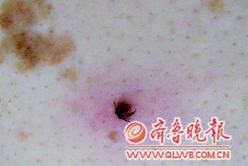 一只蜱虫叮咬在皮肤上。(图片由王德旭
