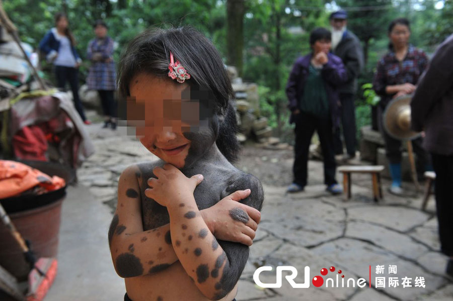 2012年6月5日，贵州省清镇市流长乡有一个女孩全身60%的皮肤布满黑点，还长着绒毛。  丽丽一出生就和常人不一样，左脸布满了黑色绒毛，身上几乎全是大块小块的黑点。图片来源：cfp