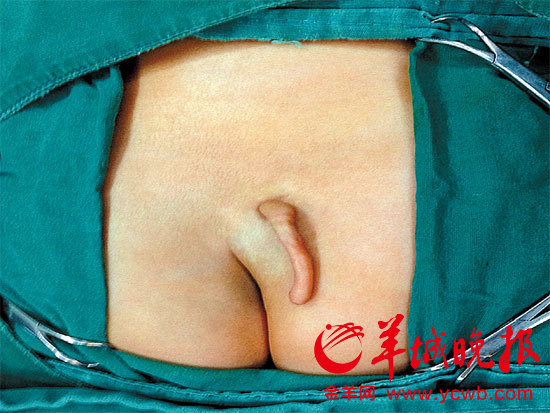 穗女婴患隐性脊柱裂 屁股上长条小尾巴