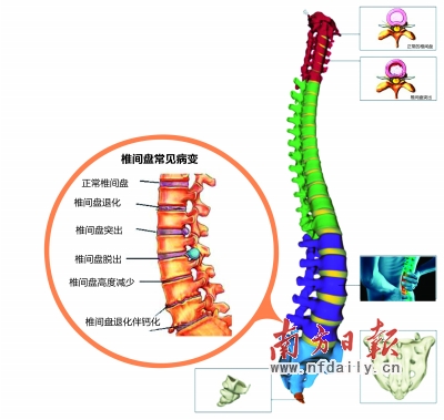 九成腰椎间盘突出患者无需手术