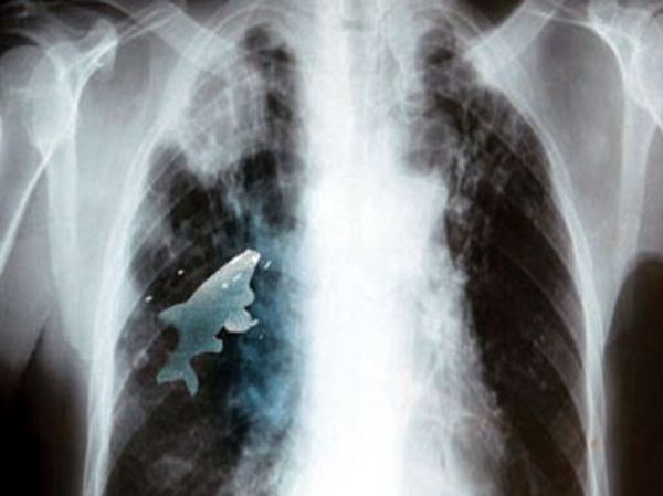 盘点人体发生的诡异事件:俄罗斯男子肺部长植