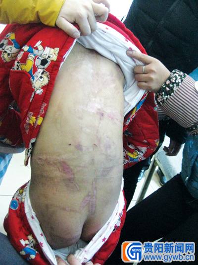 <em>12岁女孩</em>遭生母施烙刑