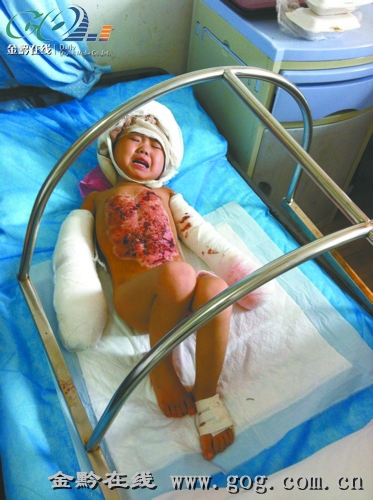 4岁小女孩跌进沸锅