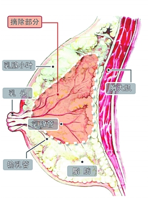 安吉丽娜·朱莉切除乳腺防癌