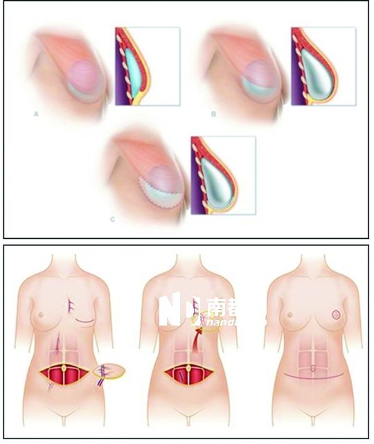 患癌切<em>乳房</em>,还可自体再造_资讯频道_凤凰网