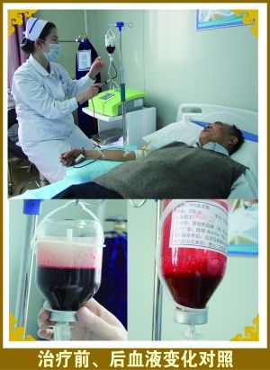 糖尿病自体血生物氧绿色疗法