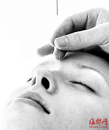 针灸放血治的是哪些病?