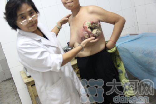 一中年女性乳腺癌来