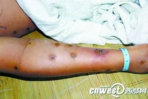 毒蜂袭扰陕西安康 3个月内230人被蜇伤21人被蜇死
