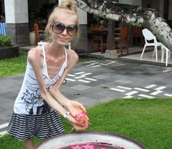 台湾<em>纸片少女</em>厌食 暴瘦到26kg猝死(图)_资讯频