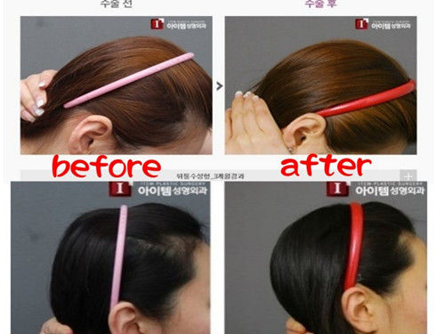 韩国后脑勺整形效果惊人 存风险医生吁谨慎|手