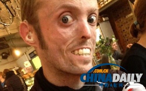 基因组测序技术帮忙破解英国残疾赛车手暴瘦之